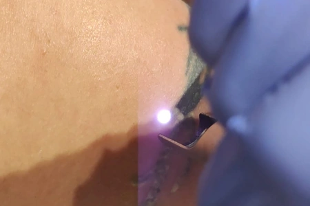 Remoción Tatuajes