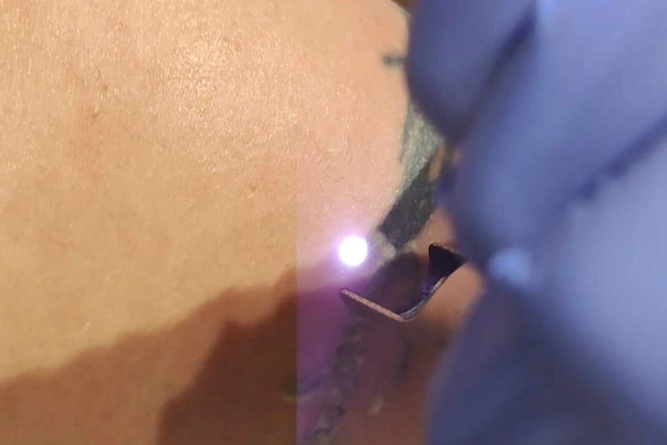Remoción Tatuajes