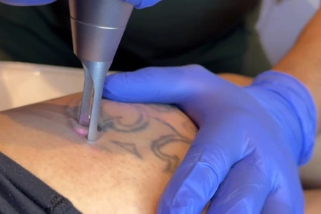 Remoción Tatuajes